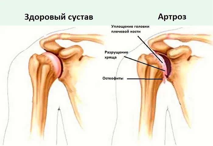 Артроз: Мифы и реальность, способы лечения и профилактики