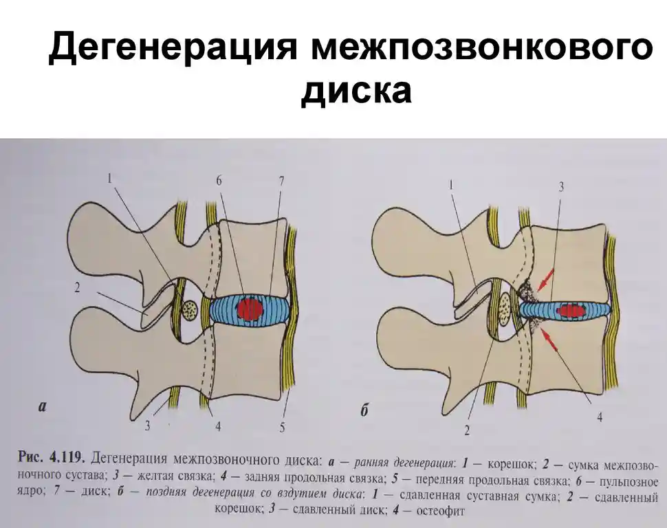 Дегенерация межпозвонковых дисков: причины, симптомы и профилактика