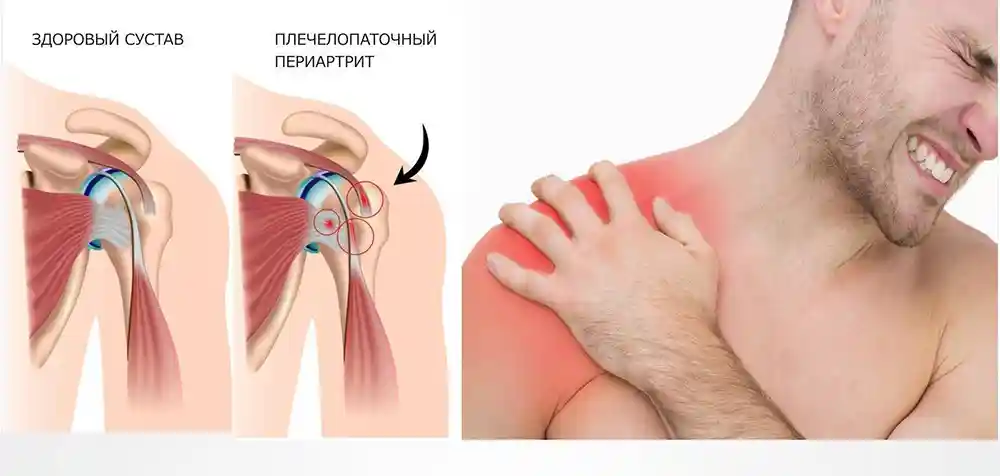 Плечелопаточный периартрит: Как Боль в Плече Может Влиять на Здоровье Мозга